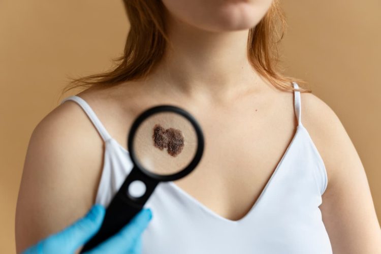 Stanley Bessa, dermatologista, explica como identificar sinais suspeitos para o câncer de pele